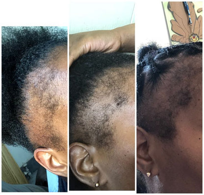 Minoxidil Hair growth Solution™