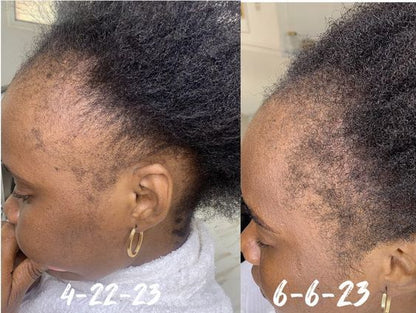 Minoxidil Hair growth Solution™